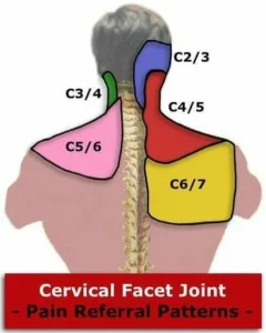 Фасетен синдром на шийните прешлени 2 болка от фасетни стави