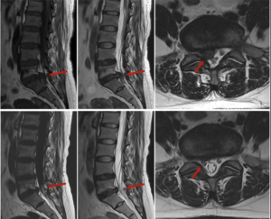 Дискова херния 6 дискова херния MRI лумбален отдел