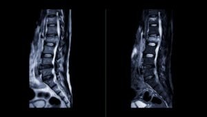 Остеохондроза 3 остеохондроза MRI лумбален отдел