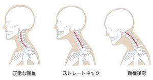 Изправена шийна лордоза 1 нормална и изправена шийна лордоза