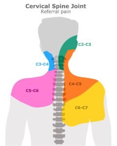 Шийна спондилоза 2 болка и напрежение във врата