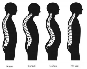 Изкривявания на гръбначния стълб 1 Какво представляват изкривяванията на гръбначния стълб