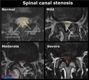Спинална стеноза 4 Как изглежда спиналната стеноза на MRI