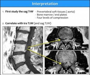 Ишиас 3 ишиас MRI лумбален отдел