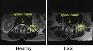Фасетен синдром 3 фасетни стави MRI лумбален отдел