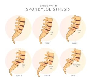 Спондилолистеза 2 спондилолистеза приплъзване на прешлен