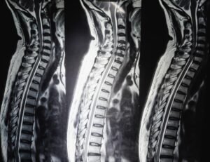 Шийна радикулопатия 3 притиснат нервен корен