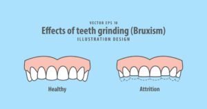 Бруксизъм (Стискане на зъби) 1 Бруксизъм (Стискане на зъби)