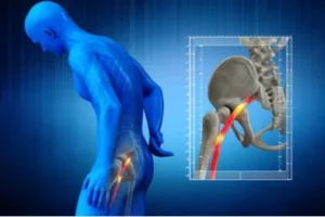 ishias biovital 450x300h - TOPAL Center - Physiotherapy and Chiropractic