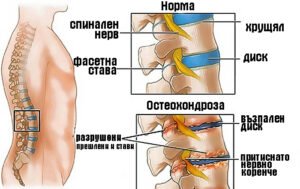 Makale hakkında daha fazla bilgi edinin Остеохондроза на гръбначния стълб – причини и симптоми