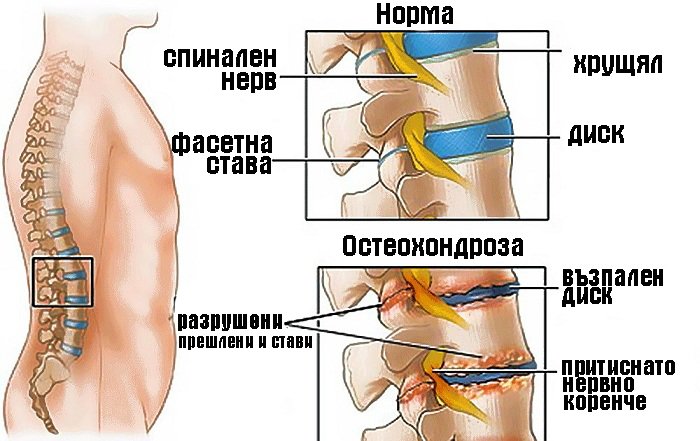 Şu anda görüntülediğiniz: Остеохондроза на гръбначния стълб – причини и симптоми
